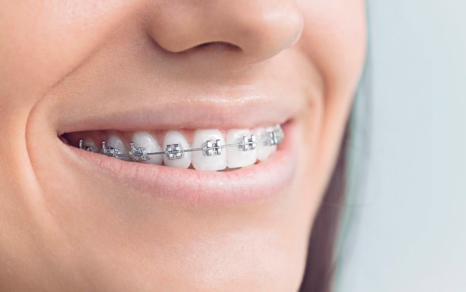 Braces Cost in Sydney