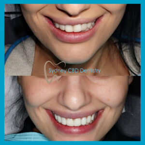 composite veneers in Sydney CBD Dentistry