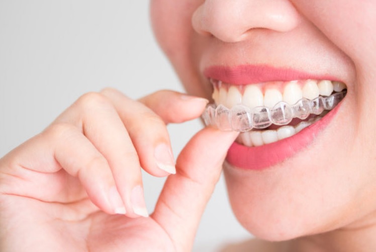 Invisalign Cost in Sydney