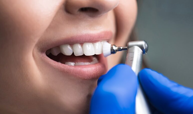 Teeth Cleaning Cost in Sydney