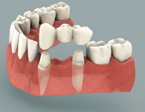 Tooth Replacement Cost