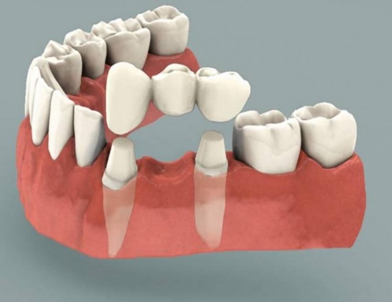 Tooth Replacement Cost Sydney CBD Dentistry