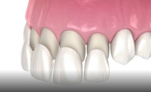 Veneers Cost