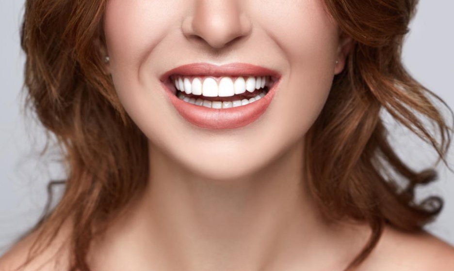 Veneers Cost