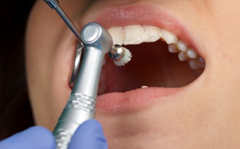 Dentist Teeth Cleaning