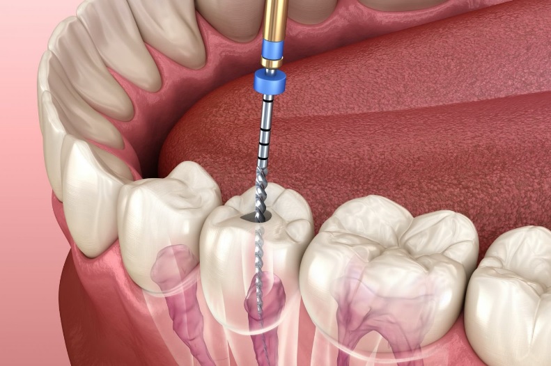 Root Canal Cost