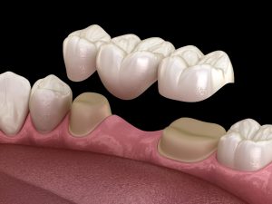 Dental Bridge Cost