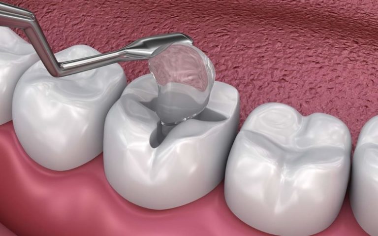 How Much Does A Filling Cost Sydney CBD Dentistry