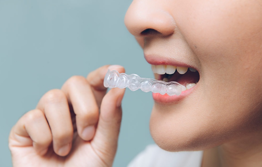 What is Invisalign