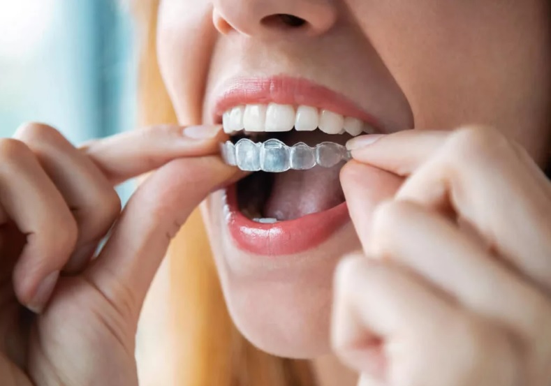 Cheap Invisalign Sydney