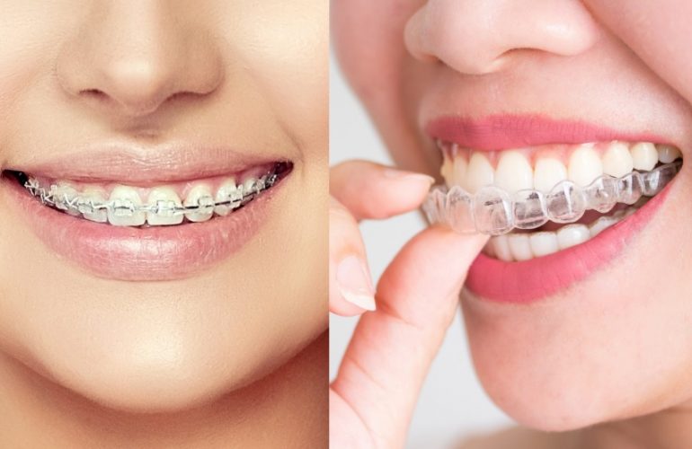 How Much Do Braces Cost?