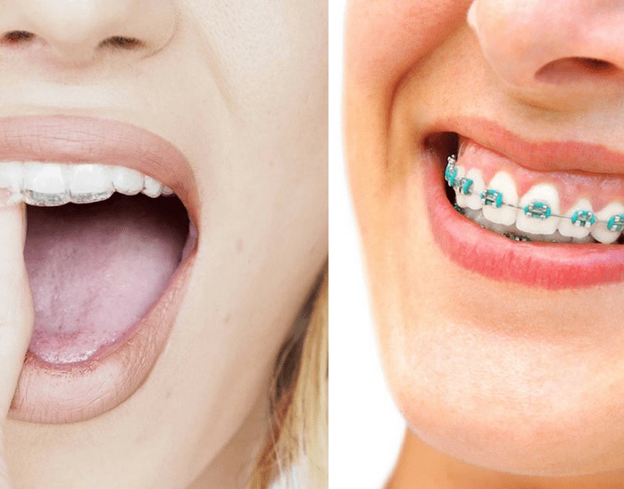 How Much Do Braces Cost?