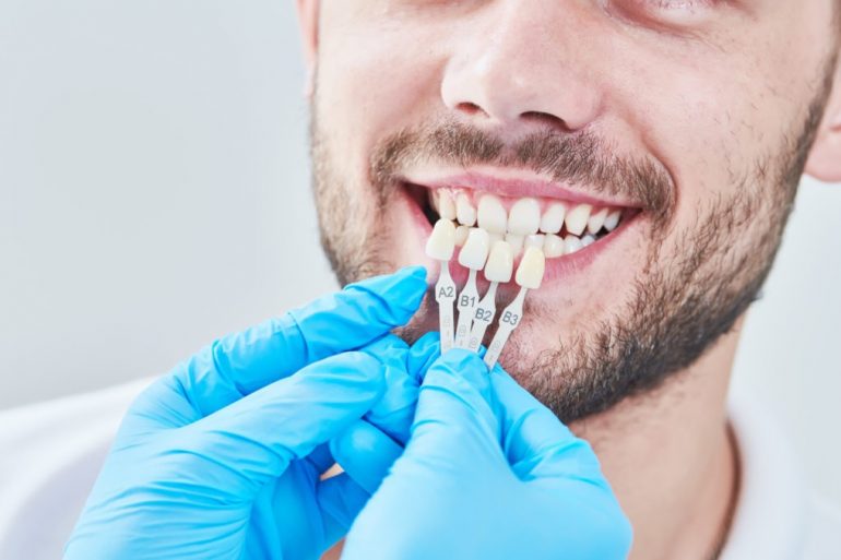 How Much Do Veneers Cost? Sydney CBD Dentistry