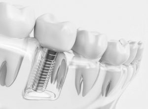 Implant Teeth Cost