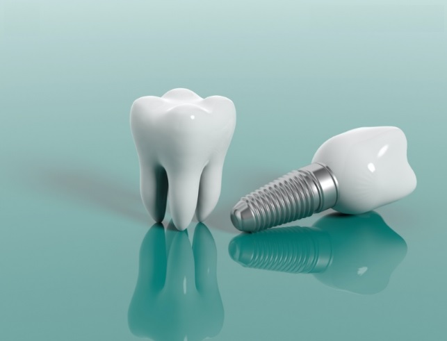 Implant Teeth Cost