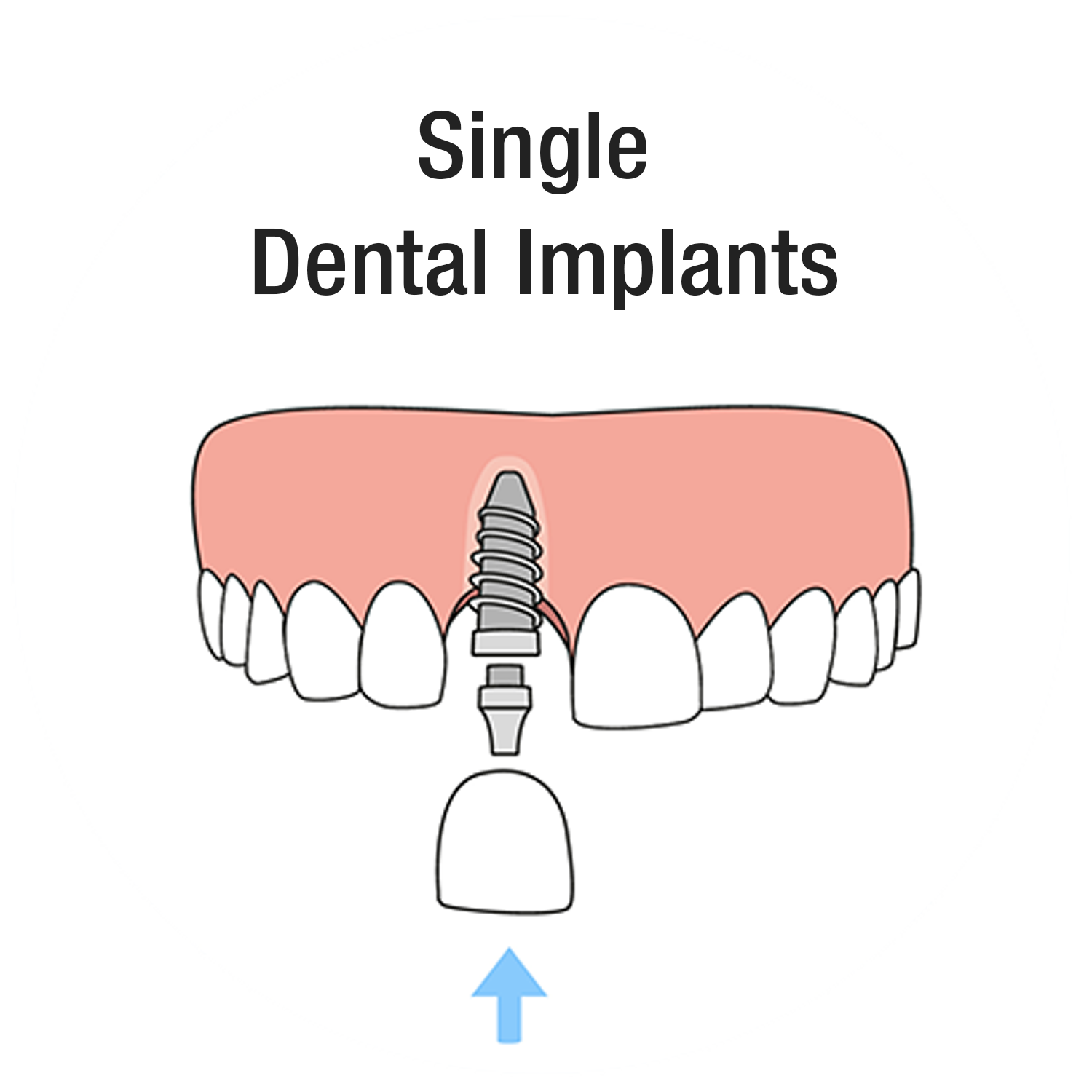 Single Dental Implants