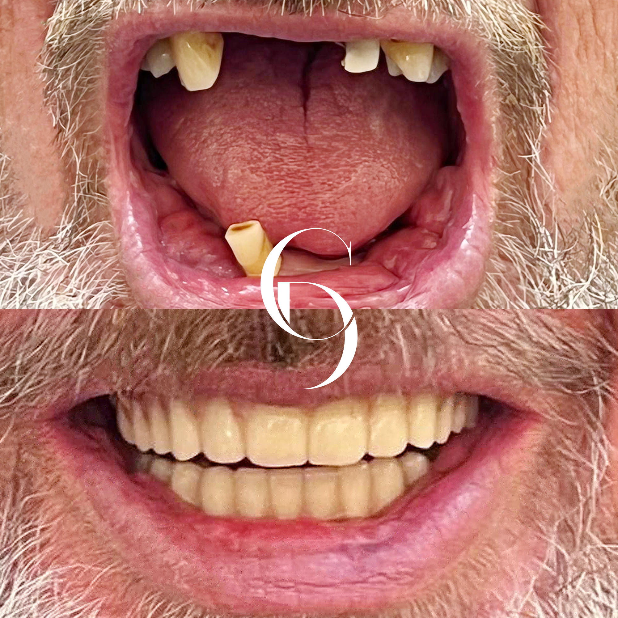 all-on-4 dental implants before and after