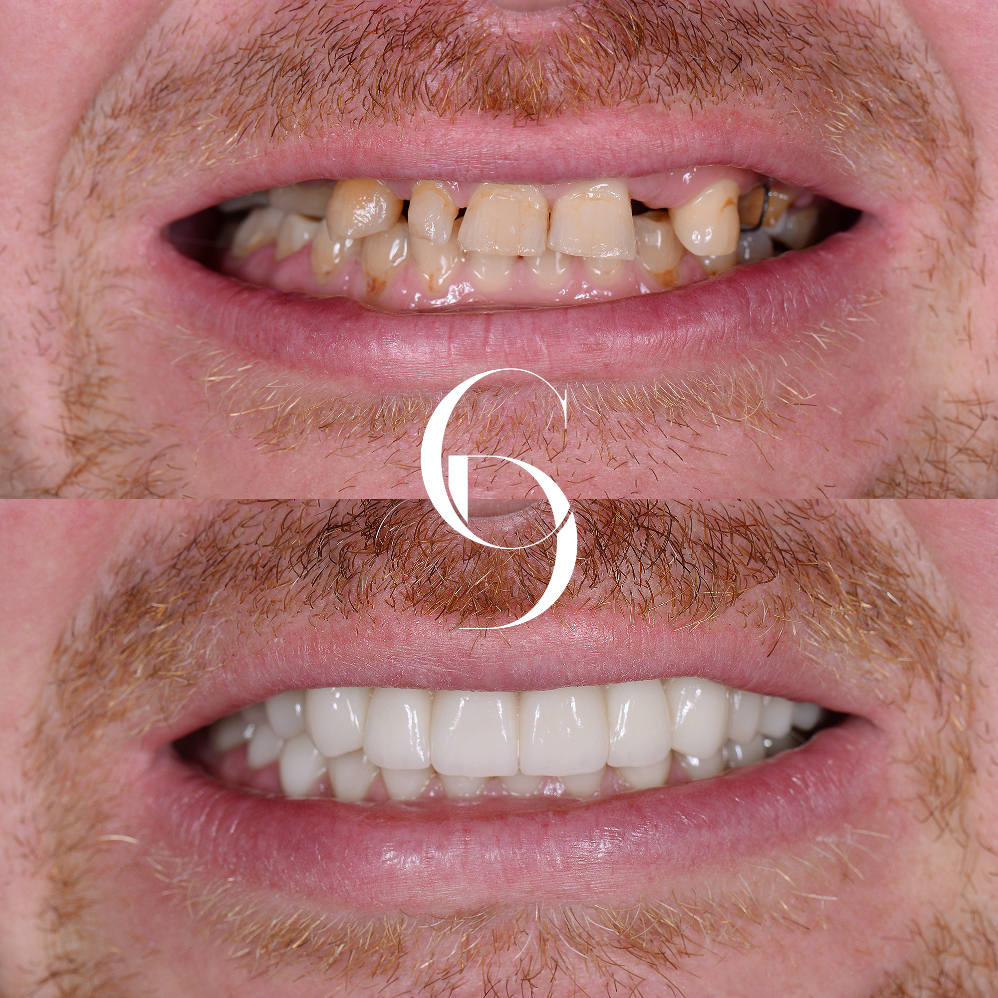 all-on-x dental implant