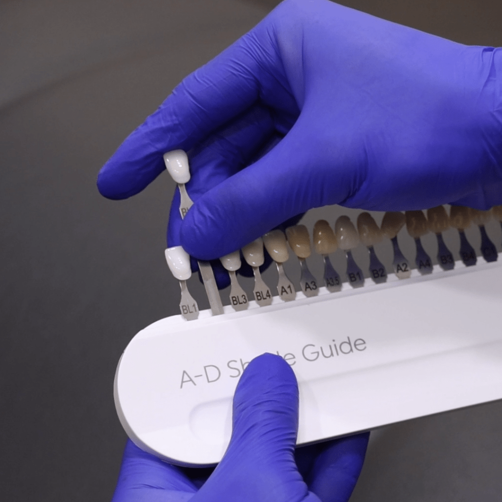 Composite Veneers