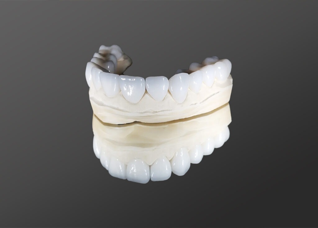 A dental model showing thin porcelain veneers placed over the front surface of human teeth to improve their appearance.