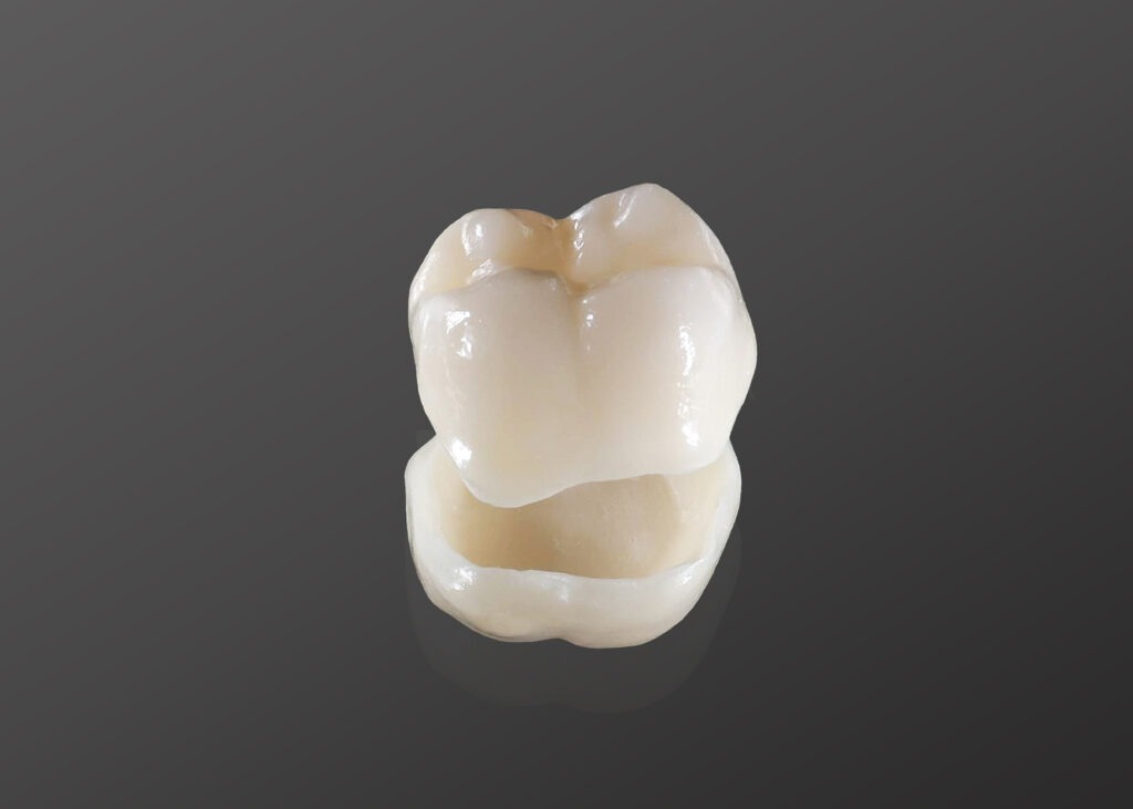 Dental crown fitted