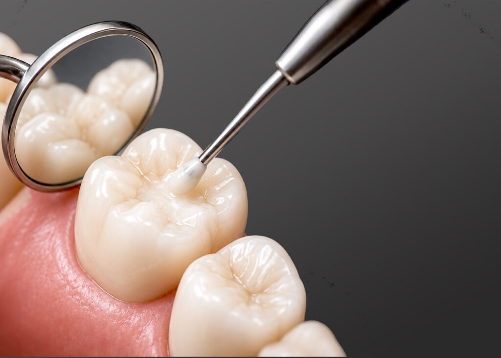 Tooth-coloured dental filling