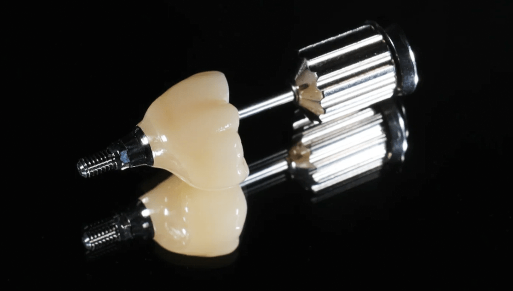 Dental implant illustration