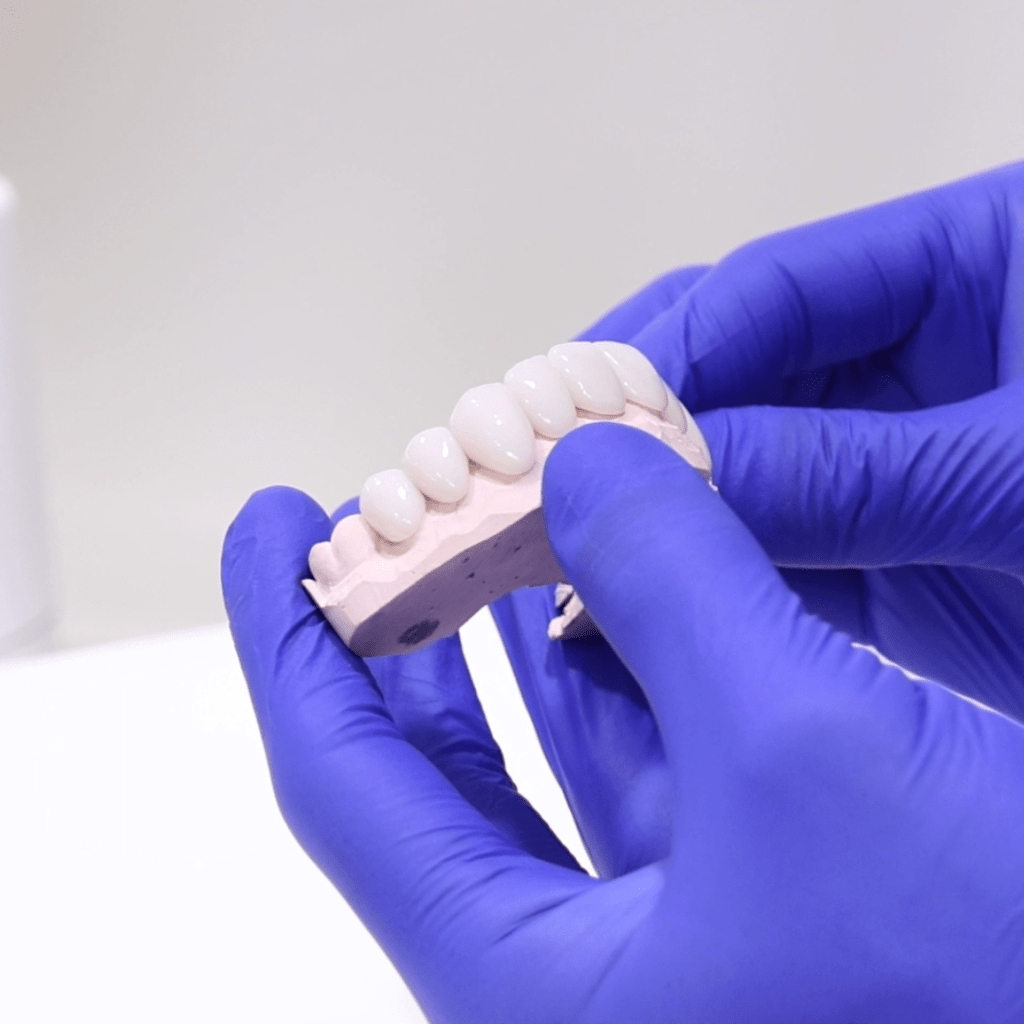 Porcelain veneers model