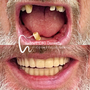 Dental Implant Sydney
