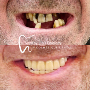 Dental Implant Sydney