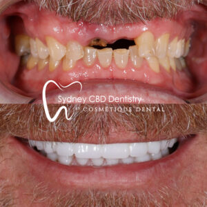 Dental Implant Sydney