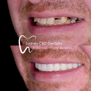 Dental Implant Sydney