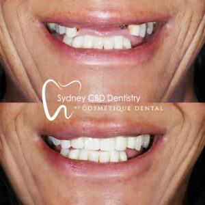 Dental Implant Sydney