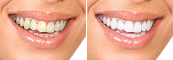Teeth Whitening: Suitability and Limitations