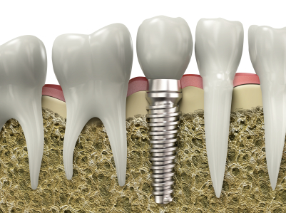 Dental Implants and Dentures: Comparing Options