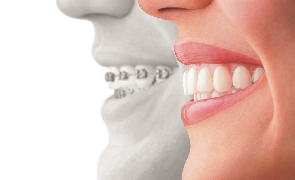 Clear Aligners and Braces: Comparing Your Options