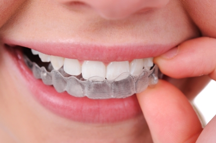 Clear Aligners and Braces: Comparing Your Options
