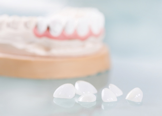 Considering Veneers: Benefits, Limits and Future Care