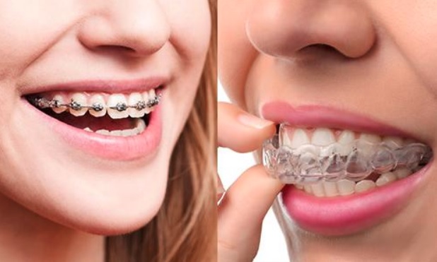 Braces Costs: What to Ask Before Treatment