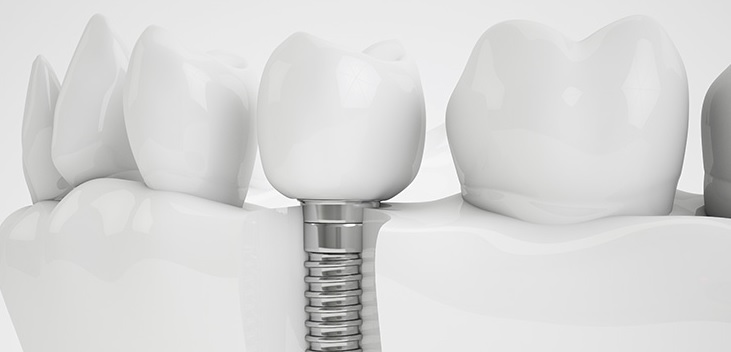 Dental Implant Costs: Weighing the Whole Decision