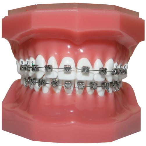 Orthodontic Treatment: Assessment to Retention