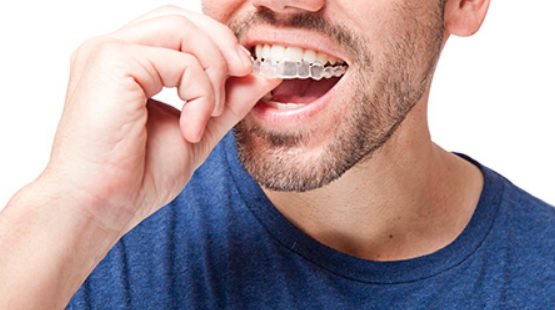 Clear Aligners: Daily Wear, Cleaning and Review
