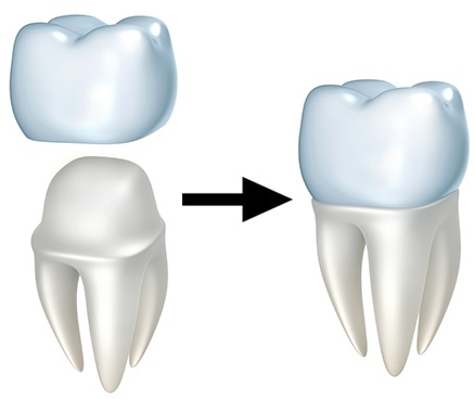 Dental Crowns: Planning Treatment in Sydney CBD