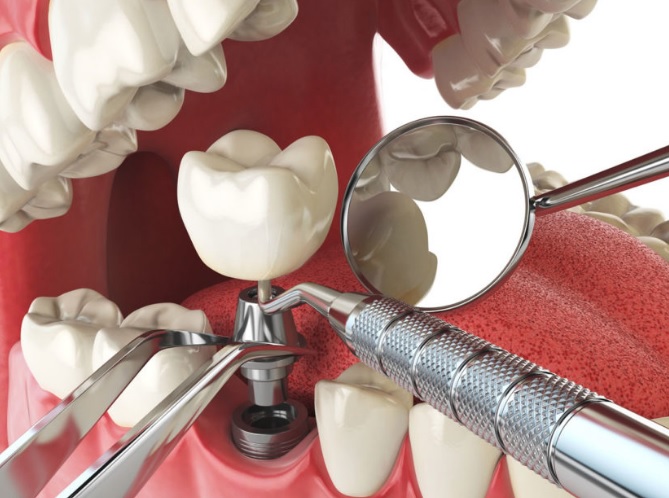 Dental Implant Maintenance and Long-Term Care