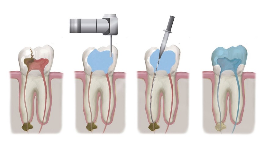 Root Canal Costs: Understanding Your Estimate