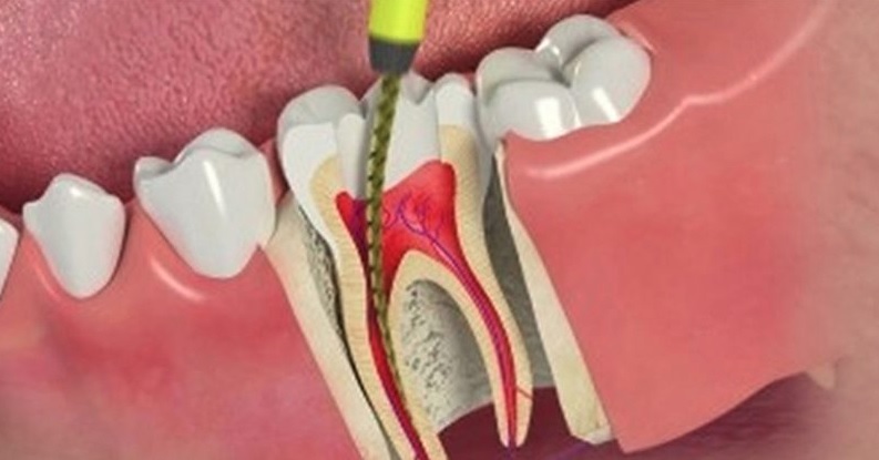 Root Canal Treatment: Planning and Follow-up