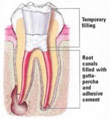 Root Canal Costs: Understanding Your Estimate