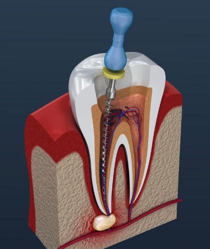 Root Canal Treatment: Planning and Follow-up