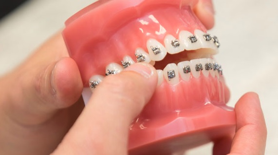 Orthodontic Assessment: Teeth, Bite and Treatment Options