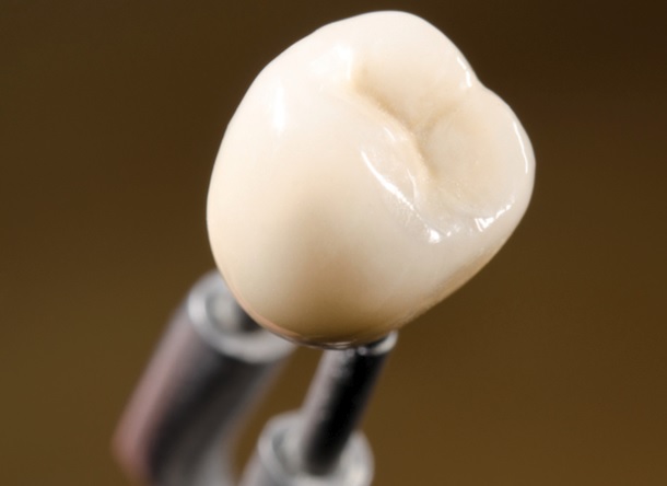 Dental Crown Costs: Questions for Your Treatment Plan
